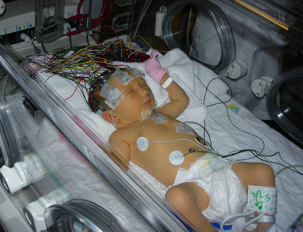 scn2a epilepsy treatment