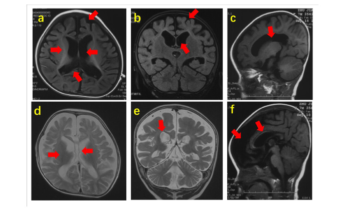 Deficiency of autism-related Scn2a gene in mice disrupts sleep patterns and circadian rhythms